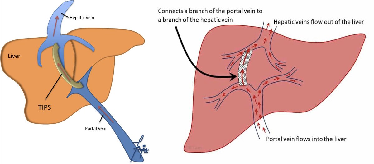 14/ So, congrats! You've just navigated the process of a TIPS procedure! We hope this was an enlightening journey. Until next time, keep exploring the fascinating world of interventional radiology! #IRad, #FutureRadRes, #MSM, #MedEd, #MedStudentMonday, #twittIR, #MedTwitter