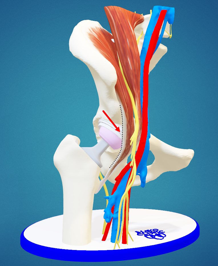 MarioHevesiMD's tweet photo. Iliopsoas tendinitis can occur after #HipReplacement and is at times treated with #Arthroscopic fractional lengthening.
Our #3DPrinting lab collaboration has allowed our dedication to education grow through diagnosis-specific models such as this for patient care and counseling. https://t.co/MKyQYXTHzM