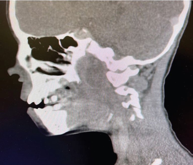 Emergency Medicine News (@emnews) on Twitter photo A 9yo boy presented with symptoms of #meningitis. <a href="/mattcarvey123/">Matthew Carvey</a> <a href="/H_Eichenlaub16/">Hayley Eichenlaub</a> <a href="/MarissaKoning/">Marissa</a> and <a href="/SmallsSono/">Courtney</a> say he had a #fever for a week, a new-onset diffuse #headache, and a lacy #rash on his chest. #Whatsthediagnosis #FOAMed bit.ly/3NSE9d7 A 9yo boy presented with symptoms of #meningitis. <a href="/mattcarvey123/">Matthew Carvey</a> <a href="/H_Eichenlaub16/">Hayley Eichenlaub</a> <a href="/MarissaKoning/">Marissa</a> and <a href="/SmallsSono/">Courtney</a> say he had a #fever for a week, a new-onset diffuse #headache, and a lacy #rash on his chest. #Whatsthediagnosis #FOAMed bit.ly/3NSE9d7