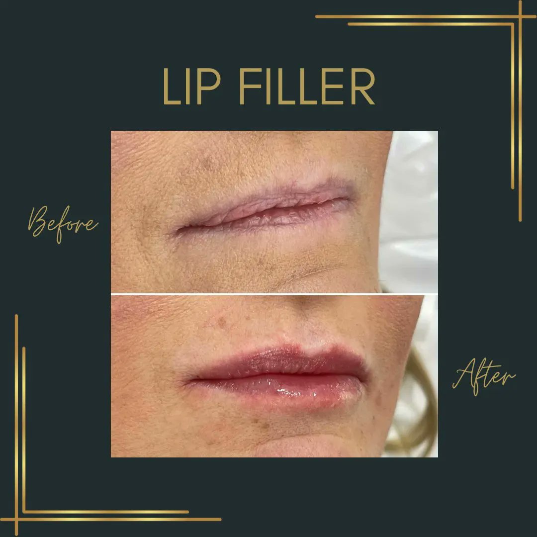 LtdSmooth's tweet photo. Lip Filler 👄 

Such a natural look for these beautiful lips ✨ You don’t need a lot to enhance what you already have 💚

We offer 0.5ml lips at £175 or upgrade to our premium 0.5ml lips for £250. Message today to book in 💌 #lipfiller #lipaesthetic #lipaesthetics https://t.co/ovgiv9flg3