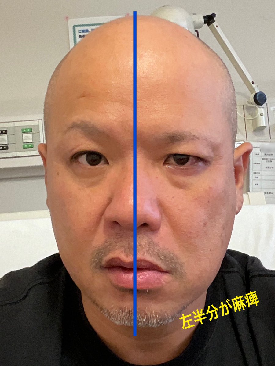 seisoon1204's tweet photo. 先週末、朝起きたら顔の左半分が動かない🫤 ひどい耳鳴りもする😖
慌てて病院に行ったら即入院🏥

ステロイド点滴を打って治すらしい
原因は？ ストレス？ なのぉ？
#入院
#ステロイド治療
#顔面麻痺
#ベル麻痺
#ハーレーダビッドソン
#FLHTCU https://t.co/8auN6ikAIO