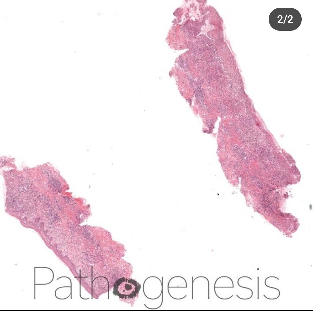 sakhurram's tweet photo. @theBSOMP Case of the Month for July/Aug 23 is now live.

Visit https://t.co/ty7l4MpYak for history, wholeslide image, diagnosis &amp; learning points.

WSI credit- Pathogenesis Digital Pathology
https://t.co/GsH95hWgw2

#bsomp #COTM #oralpathology #pathology #headandneckpathology https://t.co/ZJALEEVZja
