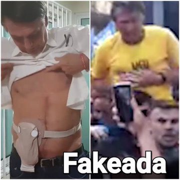 1 - Médicos não operam sem usar luvas.
2 - Muito menos com camisa suja em cima da maca (vejam a blusa amarela). 
3 - Anestesiadas não fazem cara de dor. 
4 - A cicatriz horizontal na barriga do genocida não é no local onde supostamente foi faqueado.