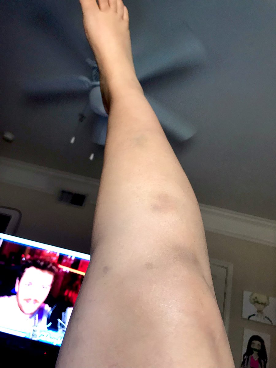 Ssenpaith1ccums's tweet photo. My baby Thicc thighs and legs can only take so much. 🥲

If you think this is bad. You should see my arms. 🥹😭

Also I was watching @CDawgVA 🥰

#AdultingAndStuff #workingwoman #bruisesfordays https://t.co/84vzC9MZAP