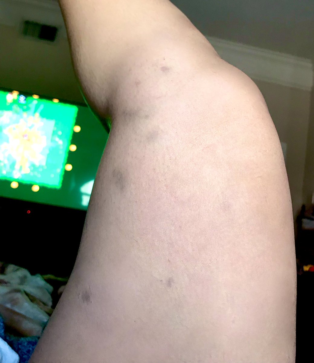 Ssenpaith1ccums's tweet photo. My baby Thicc thighs and legs can only take so much. 🥲

If you think this is bad. You should see my arms. 🥹😭

Also I was watching @CDawgVA 🥰

#AdultingAndStuff #workingwoman #bruisesfordays https://t.co/84vzC9MZAP