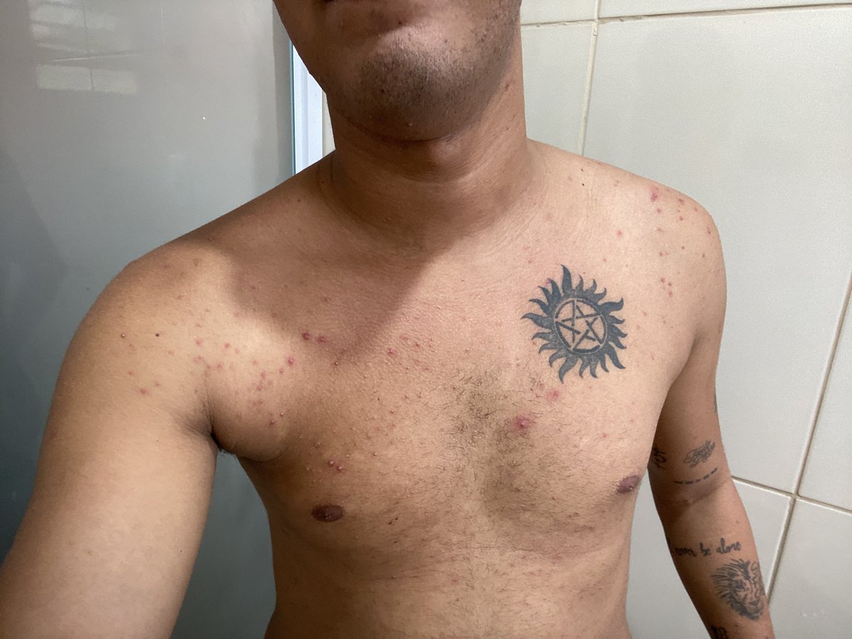 edulop's tweet photo. Alguém quer catapora ? 
25 anos depois... https://t.co/rDomSd9fTs