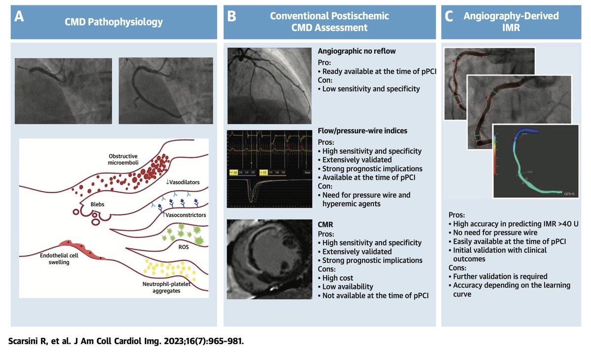 next frontier for primary #PCI is microvascular obstruction treatment. but first of all it is important to diagnose it. here a  state of the art on how to recognize #MVO recognition. which is the treatment?jacc.org/doi/10.1016/j.…