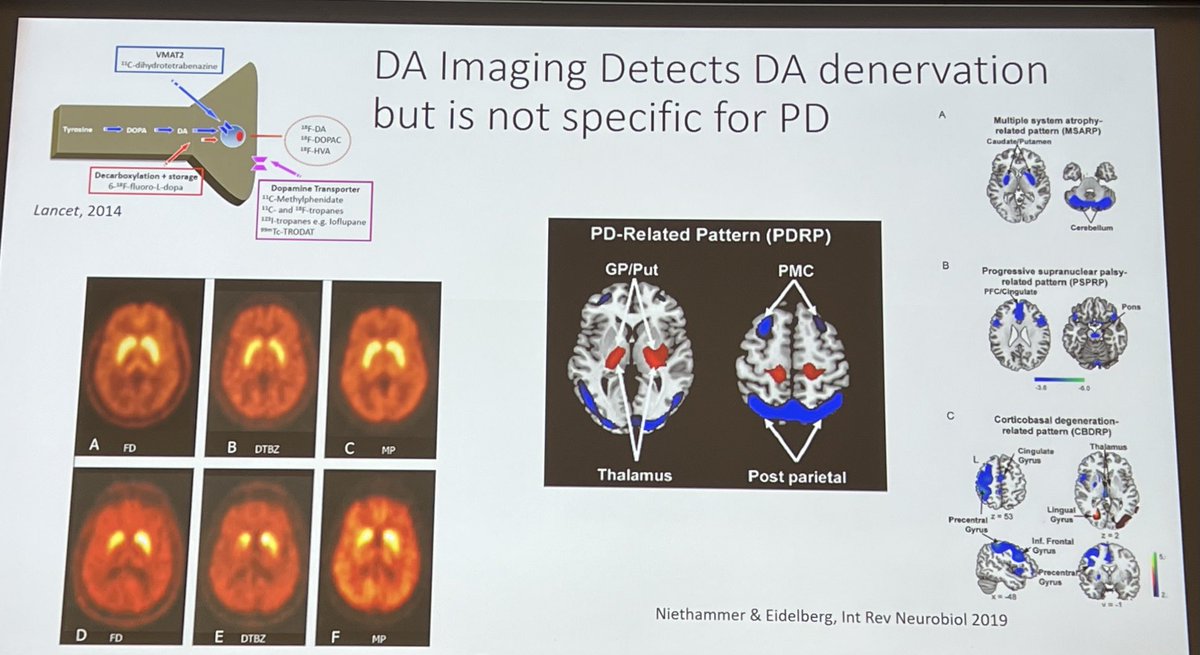 MichaelOkun's tweet image. Here is an important point made today. Dopamine imaging detects dopamine denervation but is NOT specific to Parkinson’s Disease. Thanks to John Stoessel ⁦@UBC⁩ #wpc2023