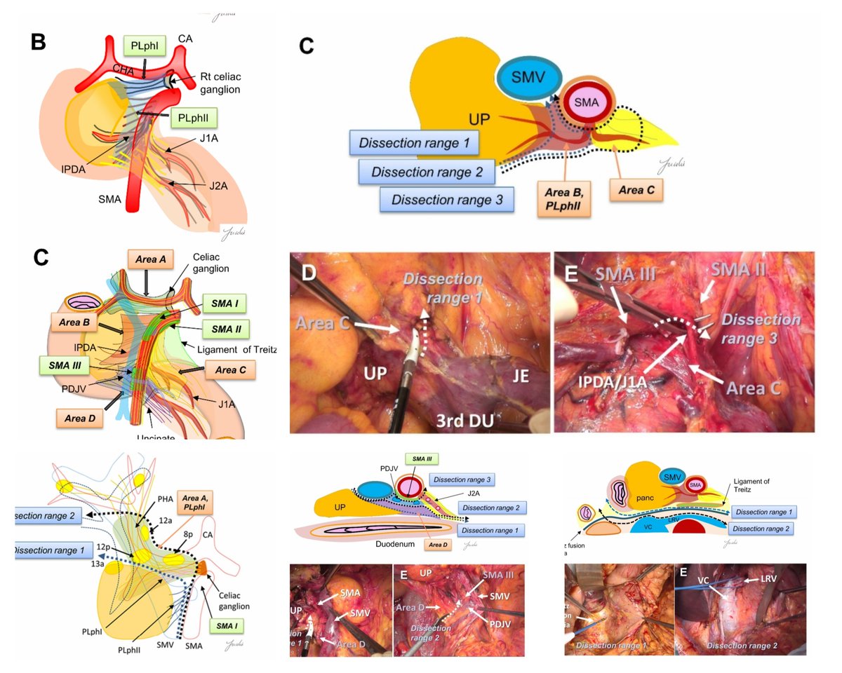 Reconsideration of the Appropriate Dissection Range Based on Japanese Anatomical Classification for Resectable Pancreatic Head Cancer in the Era of Multimodal Treatment        <a href="/YuichiNagakawa/">Yuichi Nagakawa</a>