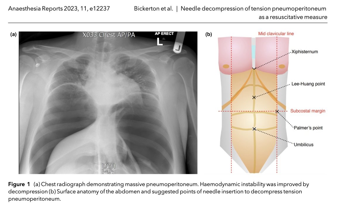 Have you ever had to do a needle decompression of a tension pneumoperitoneum in an unstable patient prior to the induction of general anaesthesia? @bickerton_matt et al write about their experience here: …-publications.onlinelibrary.wiley.com/doi/full/10.10…