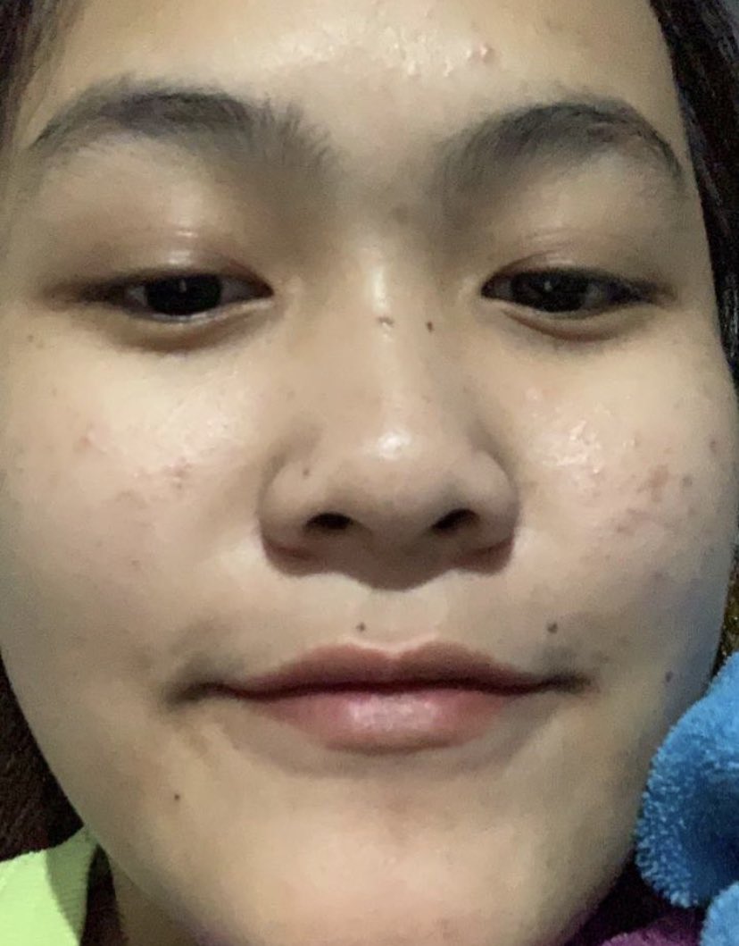 sundakentel's tweet photo. ⋆.✧̣̇˚ cara aku menghilangkan bekas jerawat ⋆.✧̣̇˚

contains : 
— Tips 
— Rekomendasi produk 

#skincareroutine https://t.co/vl2Y1ZYv97