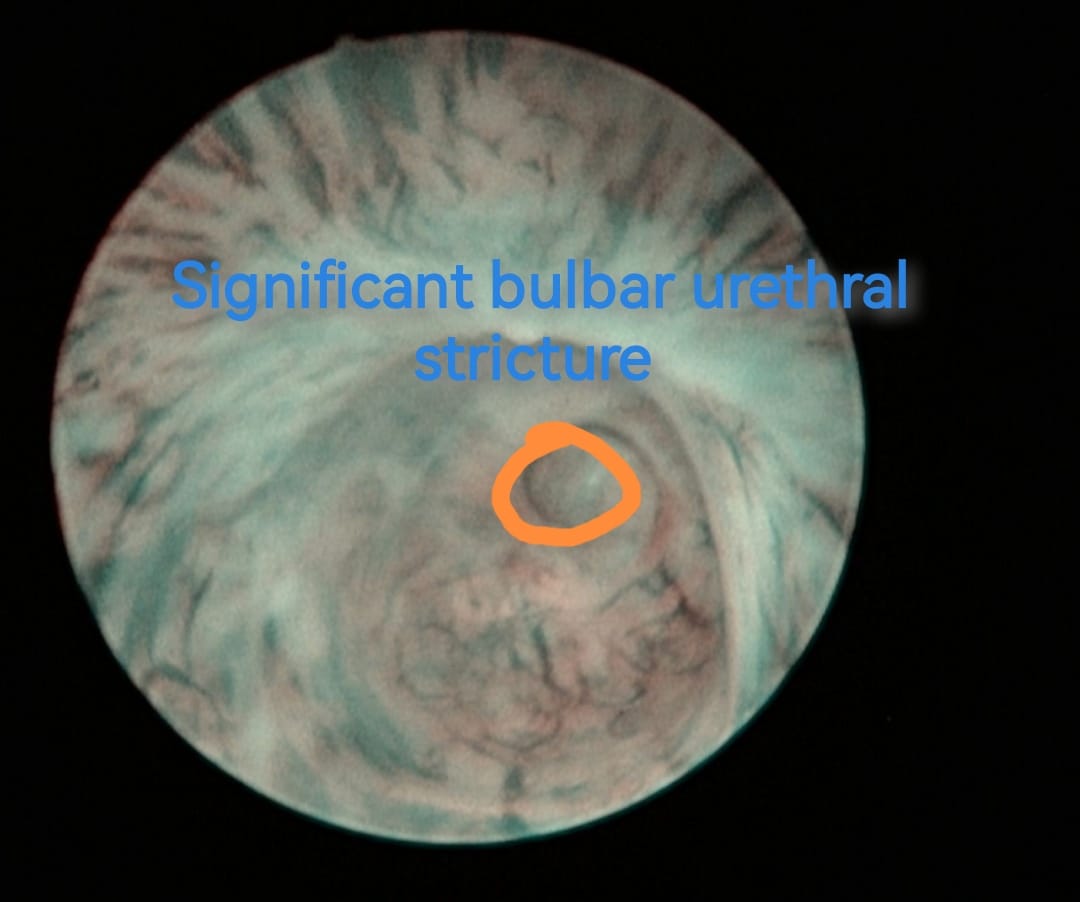 OTosev's tweet photo. Can you see the difference in the first and the last picture: before and after correct placement of Optilume-Balloon? #Optilume #Tosev https://t.co/kC0ABGu0Te