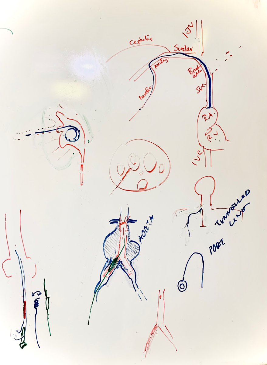 Drawings on the board for the medical students. #InterventionalRadiology