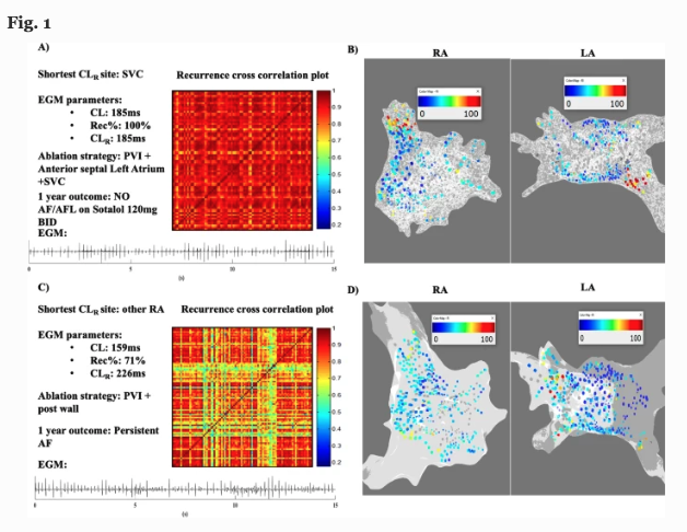 JICE_EP's tweet photo. 🚨New #FreeRead in @JICE_EP

EGM Morphology Recurrence Guided Catheter Ablation for Repeat Ablation of Persistent Atrial Fibrillation

R Mitrani, @ghaith_zaatari J Bohorquez, J Ng, @RivnerHarold A Velasquez @DrLitsaL R Arora &amp; @DrJGoldberger

🧐📖 https://t.co/a7z7hYBiIZ

#EPeeps https://t.co/d5wvdCnVMm