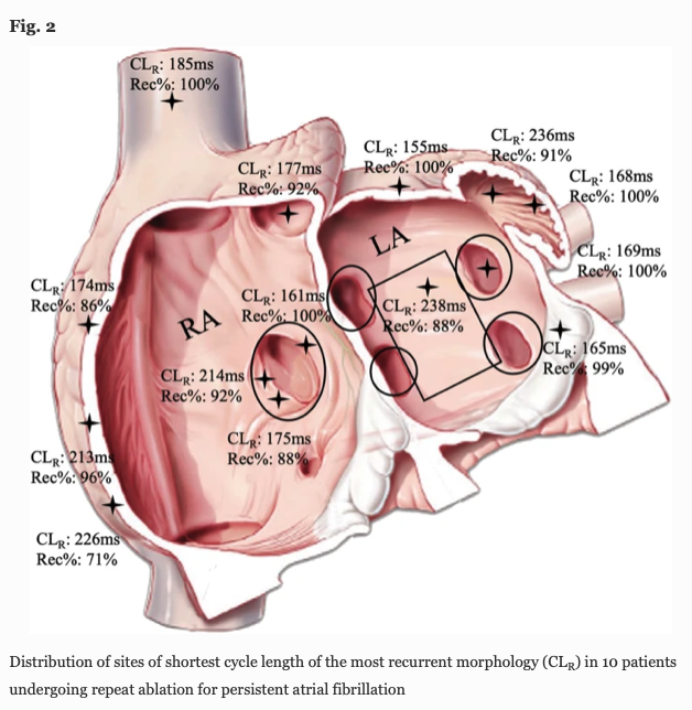 JICE (@jice_ep) on Twitter photo 🚨New #FreeRead in <a href="/JICE_EP/">JICE</a>
EGM Morphology Recurrence Guided Catheter Ablation for Repeat Ablation of Persistent Atrial Fibrillation
R Mitrani, <a href="/ghaith_zaatari/">Ghaith Zaatari MD, MS</a> J Bohorquez, J Ng, @RivnerHarold A Velasquez <a href="/DrLitsaL/">Litsa Lambrakos</a> R Arora & <a href="/DrJGoldberger/">Jeffrey Goldberger</a>
🧐📖 rdcu.be/df2fp
#EPeeps 🚨New #FreeRead in <a href="/JICE_EP/">JICE</a>
EGM Morphology Recurrence Guided Catheter Ablation for Repeat Ablation of Persistent Atrial Fibrillation
R Mitrani, <a href="/ghaith_zaatari/">Ghaith Zaatari MD, MS</a> J Bohorquez, J Ng, @RivnerHarold A Velasquez <a href="/DrLitsaL/">Litsa Lambrakos</a> R Arora & <a href="/DrJGoldberger/">Jeffrey Goldberger</a>
🧐📖 rdcu.be/df2fp
#EPeeps