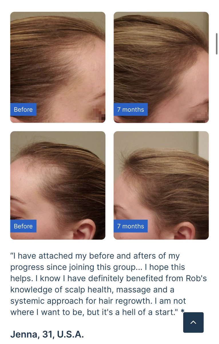 和難得從中國工作回台放假的麻吉汪醫師敘舊，聽到一個目前最前沿的落髮知識，趁記憶猶新，經同意分享一下。

汪醫師當年是我這屆學霸中的學霸，建中全校第一畢業，台大醫科第一名畢業，拿到醫師執照後沒走住院醫師流程，直接攻醫美領域，現在在上海高端醫美診所做，主攻針劑。