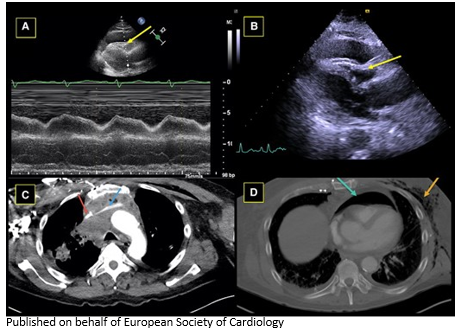 European Society of Cardiology Journals (@esc_journals) on Twitter photo The big squeeze: balancing the hemodynamics of cardiac tamponade and superior vena cava syndrome. bit.ly/44kjVil
#EHJCaseReports <a href="/KardiologieHH/">Erik Rafflenbeul</a> <a href="/aayshacader/">Aaysha Cader</a> <a href="/ANazmiCalik/">A.Nazmi Calik</a> <a href="/TJ_Yeo/">Tee Joo YEO</a> <a href="/Phiso_de/">Philipp Sommer</a> <a href="/EHJCREiC/">EHJCaseReports Editor-in-Chief</a> <a href="/FarhanaAra/">Farhana</a> The big squeeze: balancing the hemodynamics of cardiac tamponade and superior vena cava syndrome. bit.ly/44kjVil
#EHJCaseReports <a href="/KardiologieHH/">Erik Rafflenbeul</a> <a href="/aayshacader/">Aaysha Cader</a> <a href="/ANazmiCalik/">A.Nazmi Calik</a> <a href="/TJ_Yeo/">Tee Joo YEO</a> <a href="/Phiso_de/">Philipp Sommer</a> <a href="/EHJCREiC/">EHJCaseReports Editor-in-Chief</a> <a href="/FarhanaAra/">Farhana</a>
