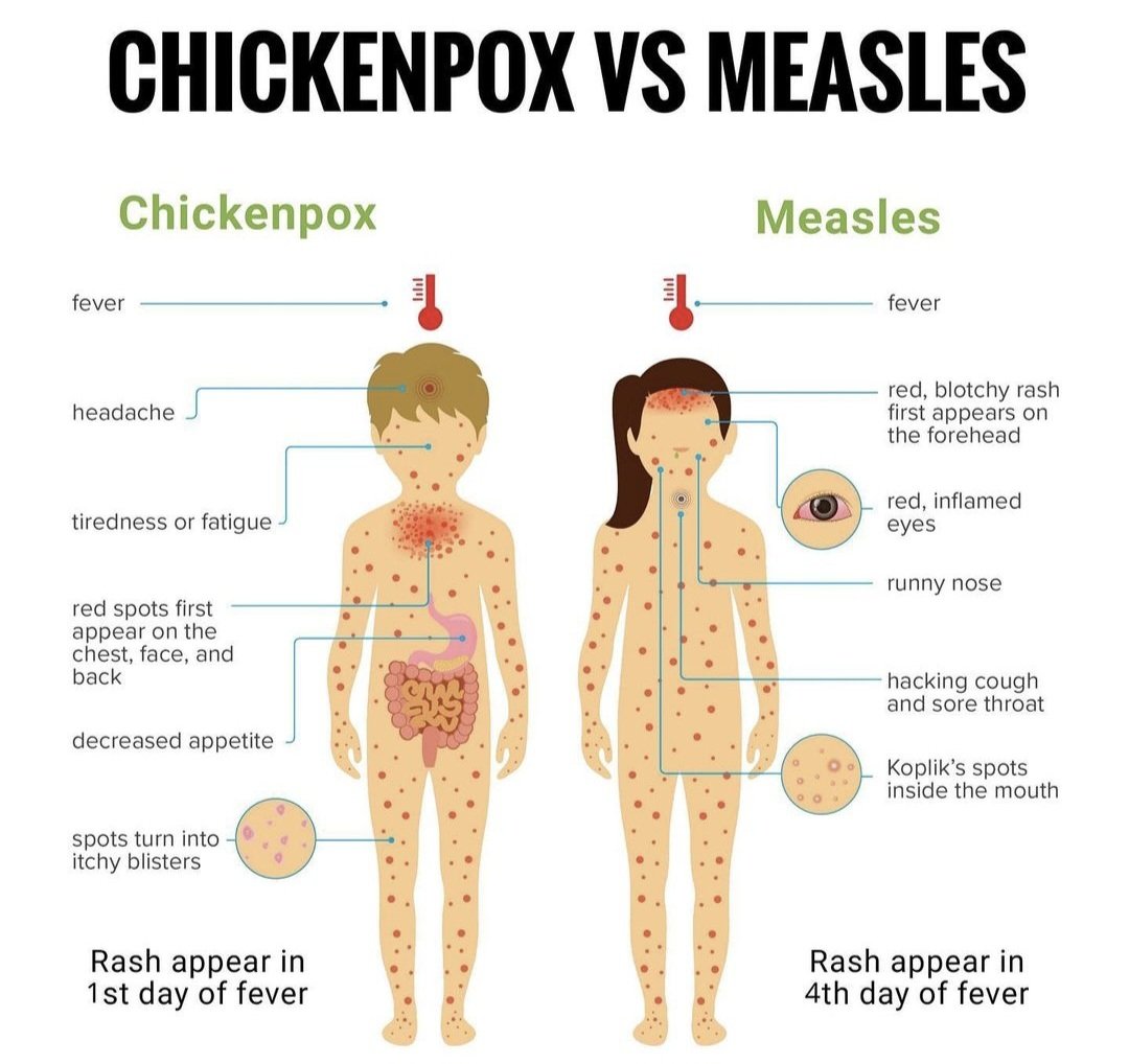 pgMedicine's tweet photo. 🐣 Chickenpox:
Caused by varicella-zoster virus.itchy rashes, fever, highly contagious!
🤒🗣️ Spread by contact &amp; respiratory droplets

�� Measles:
Highly contagious paramyxovirus.
Fever, Koplik's spots, red rash! 👁️
Spread via respiratory droplets. Serious complications! https://t.co/hpCTCqnea2