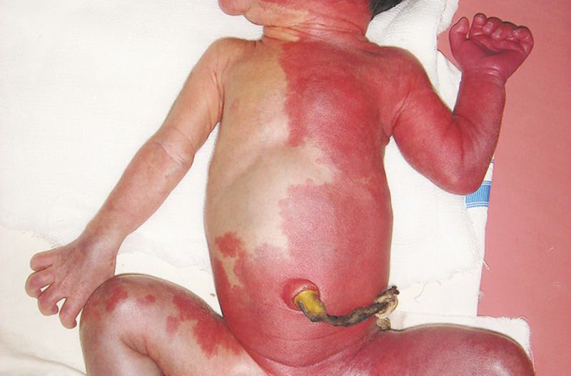 BrownJHM's tweet photo. A 4-day-old, full-term, healthy female infant underwent a change in skin color from normal to red over one half of her body. The change in color persisted for a week. What is the likely diagnosis?
@ManualOMedicine #pediatrics #medtwitter https://t.co/ETo1Gi2gy1