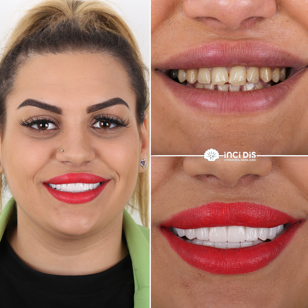 #HollywoodSmile is the perfect way to turn your smile into a work of art!

#OralHealth #HealthTourism #TurkeyHealthTourism #CosmeticDentistry #SmileDesign #DentalAesthetics  #SmileMakeover