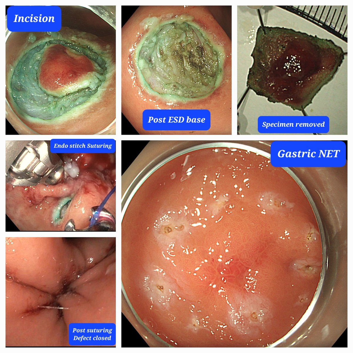 drasreekanth's tweet photo. Child A cirrhotic, elderly lady, 60yrs, severe PAH
Developed duodenal NET, EMR done in 2022, developed gastric NET, 2cmx3cm ulcerated nodular lesion
ESD done
Base closed by endo-suturing using Apollo endo-stitch in view of high risk of delayed bleeding due to cirrhosis with PAH https://t.co/23gq9icNS6