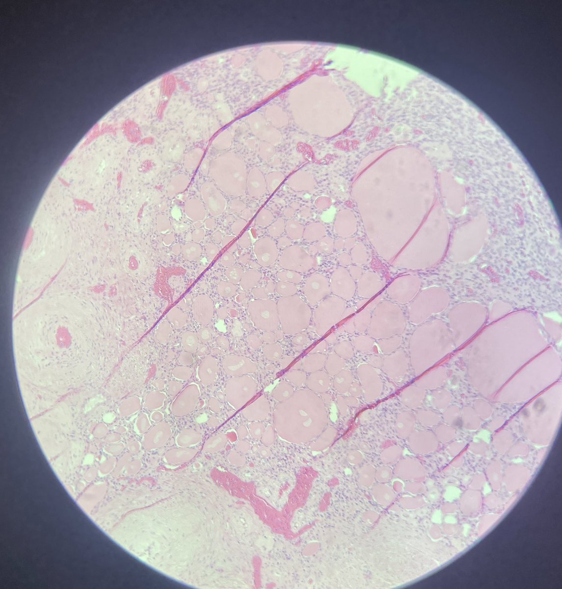 BizzarePath's tweet image. It could be thyroid but that’s not :)))))))) 
Really good piece of thyroidization of kidney 
#PathTwitter #PathFamily #MedicalTwitter #KidneyPath