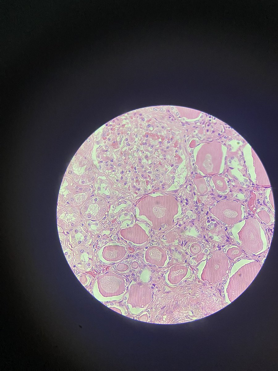 BizzarePath's tweet image. It could be thyroid but that’s not :)))))))) 
Really good piece of thyroidization of kidney 
#PathTwitter #PathFamily #MedicalTwitter #KidneyPath