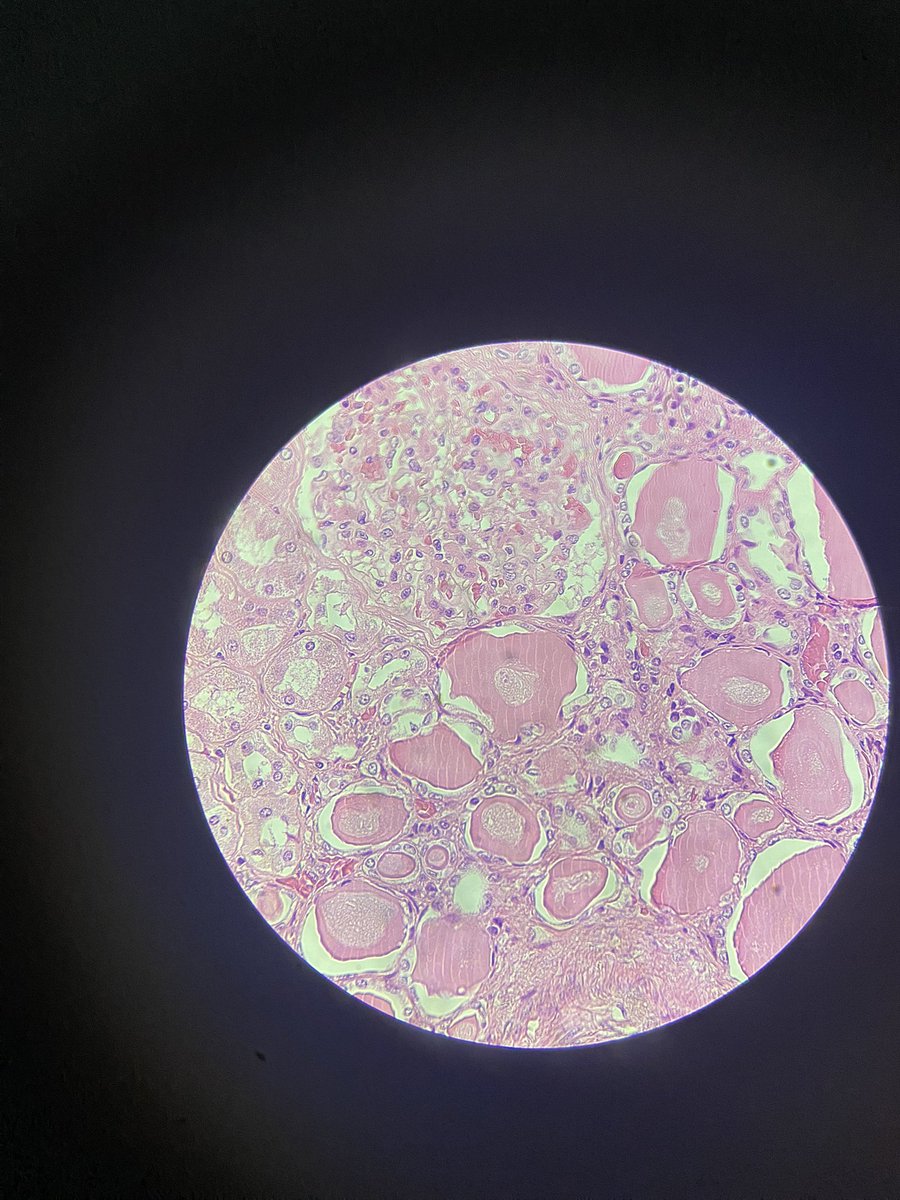 It could be thyroid but that’s not :)))))))) 
Really good piece of thyroidization of kidney 
#PathTwitter #PathFamily #MedicalTwitter #KidneyPath