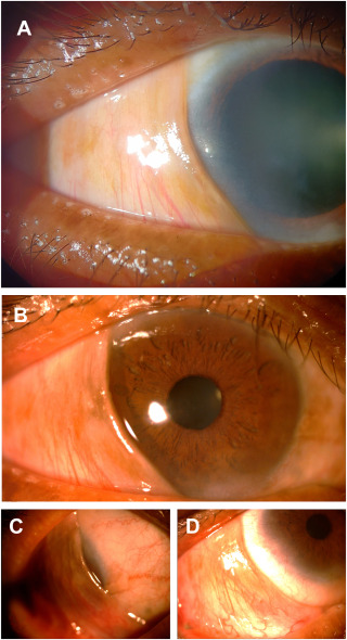 A rare case of pseudonictitating membrane ow.ly/JMa150OMfqF