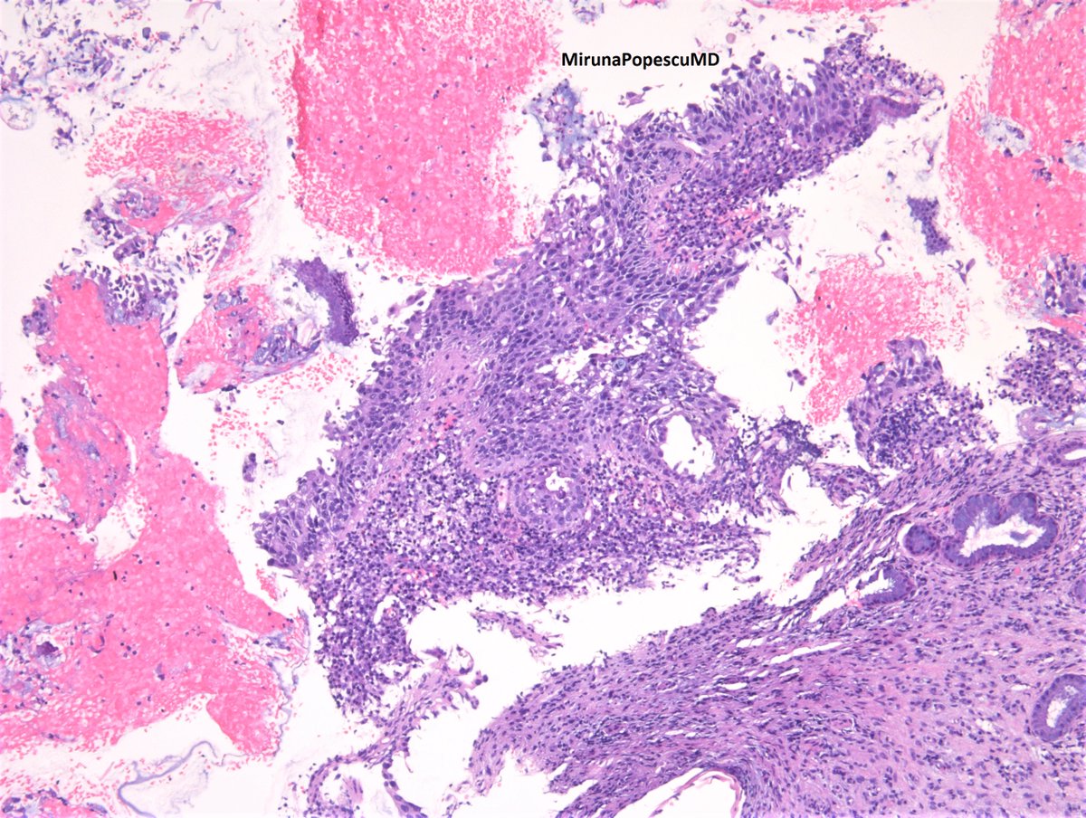 Perimenopausal F. D&C, cervix. What's your opinion? #GynPath #PathTwitter