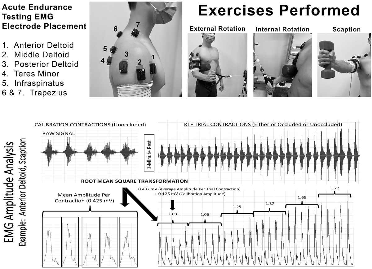 aossmjournals's tweet photo. 50% limb occlusion pressure in BFR optimizes muscle activation, discomfort, and exercise volume during rotator cuff exercises. #shoulderrehab #BFR #physicaltherapy
https://t.co/3wfrJJ6Ncp https://t.co/gdDEyAMuN9