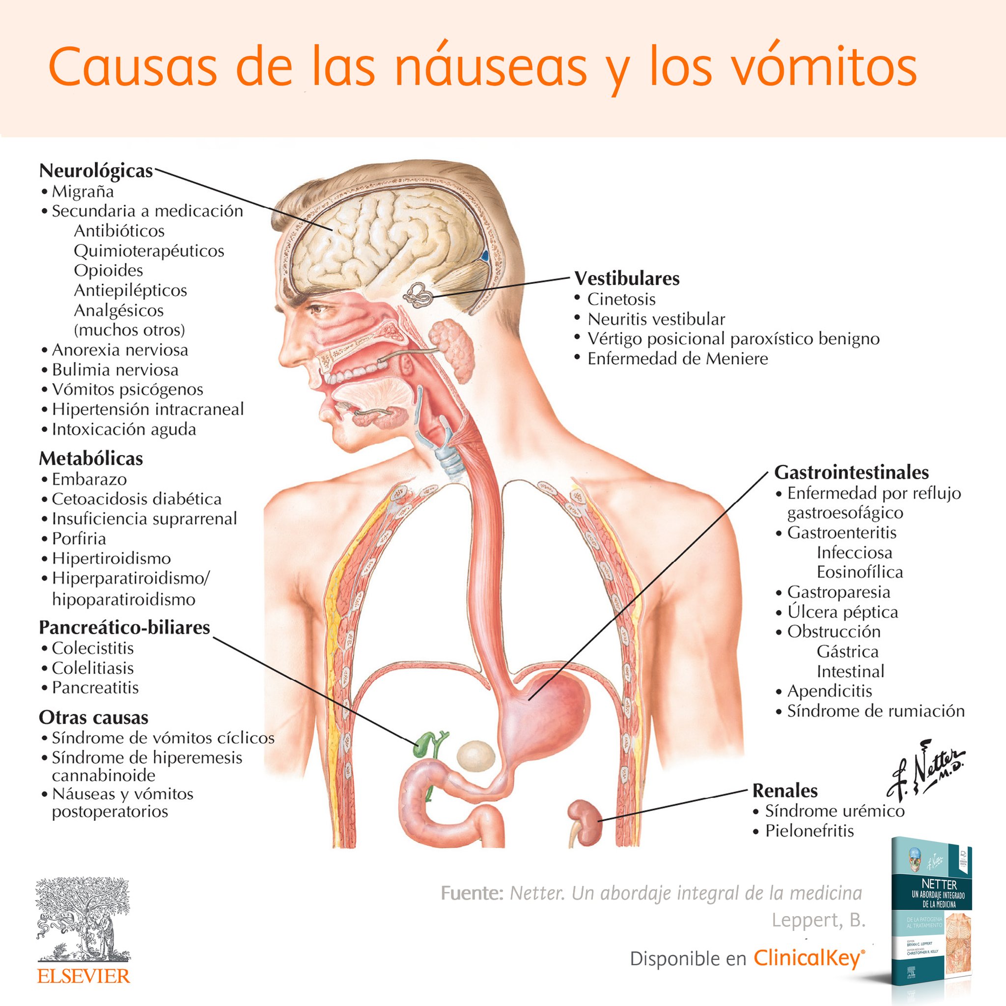 Elsevier Español on Twitter "📝 Causas de las náuseas y los vómitos