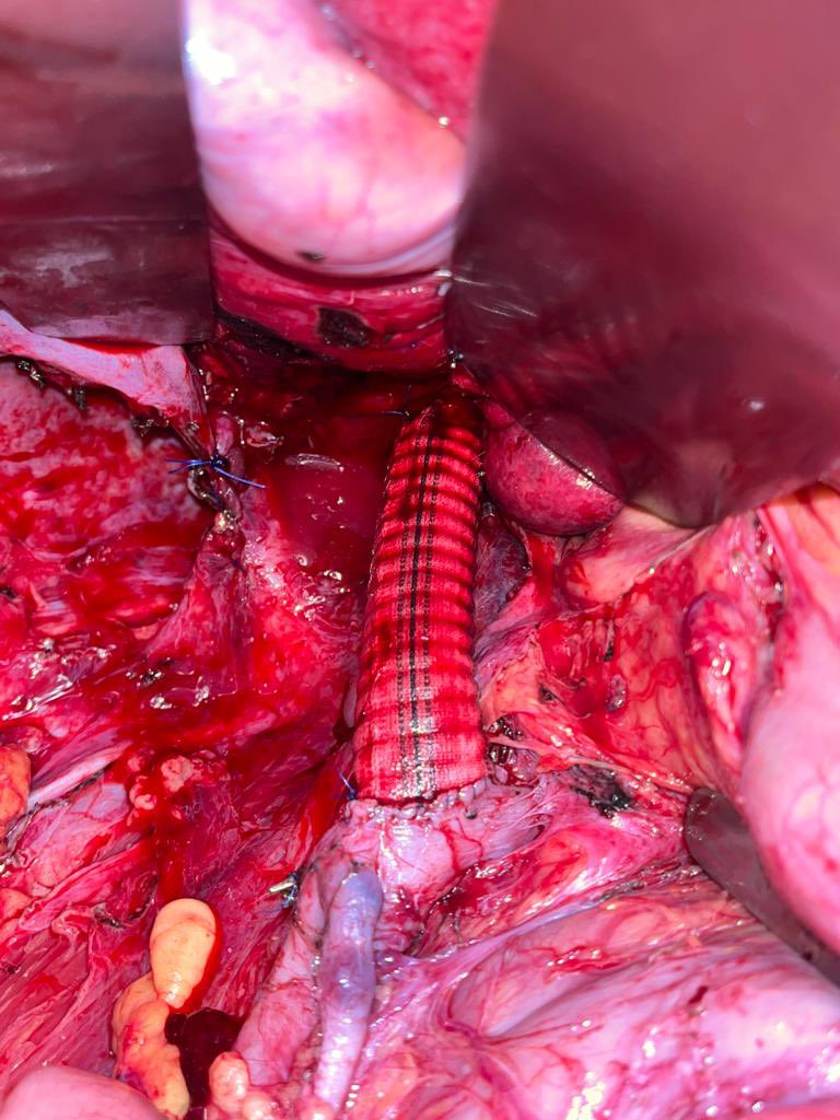 EcheverriMd's tweet photo. Metastatic melanoma to the right suprarenal gland with involvement of the inferior cava, liver and kidney: tumor resection + replacement of the retrohepatic cava vein with @CirujanoHPB https://t.co/tfqPRHCZRG