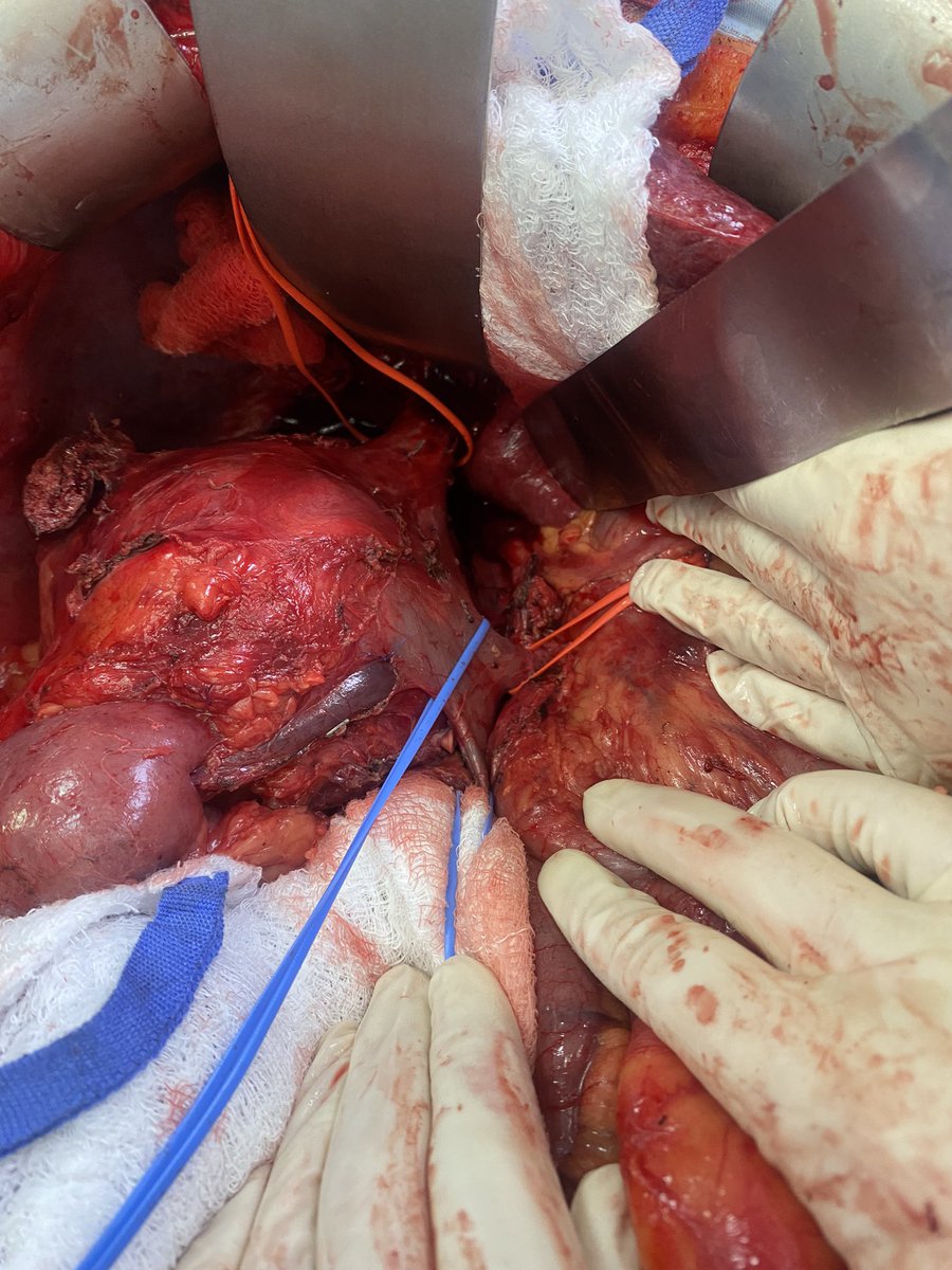 EcheverriMd's tweet photo. Metastatic melanoma to the right suprarenal gland with involvement of the inferior cava, liver and kidney: tumor resection + replacement of the retrohepatic cava vein with @CirujanoHPB https://t.co/tfqPRHCZRG