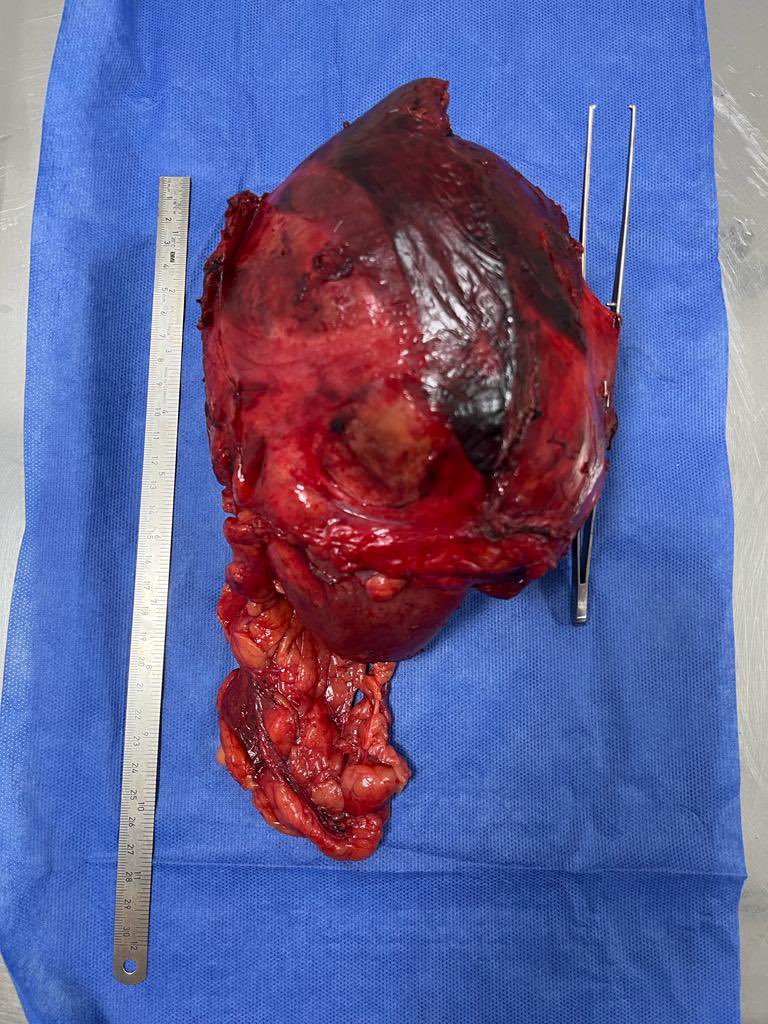 EcheverriMd's tweet photo. Metastatic melanoma to the right suprarenal gland with involvement of the inferior cava, liver and kidney: tumor resection + replacement of the retrohepatic cava vein with @CirujanoHPB https://t.co/tfqPRHCZRG