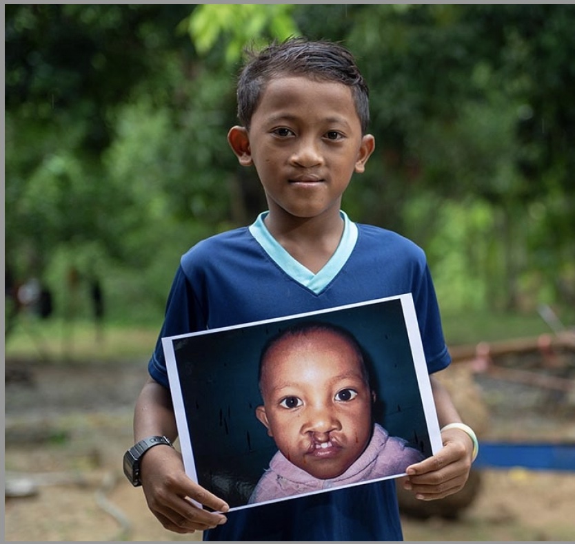New post: "Cleft lip &amp; palate month: July"  July is Cleft and Craniofacial Awareness and Prevention Month.
Full article on our amazing donor portal: csc.org/cleft-lip-pala… #csc #globalsurgery