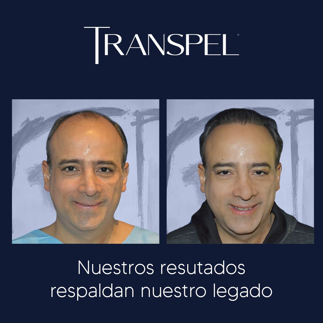 Transpel1's tweet photo. Técnica: F.U.T.
Grupos: 3,225grupos
Sesiones: 2
Dr. Abraham Munguía
Clínica: Guadalajara
Resultado final
Contacto: 33 2255 5045
WhatsApp +52 33 2255 5045 https://t.co/dQX0izSGno