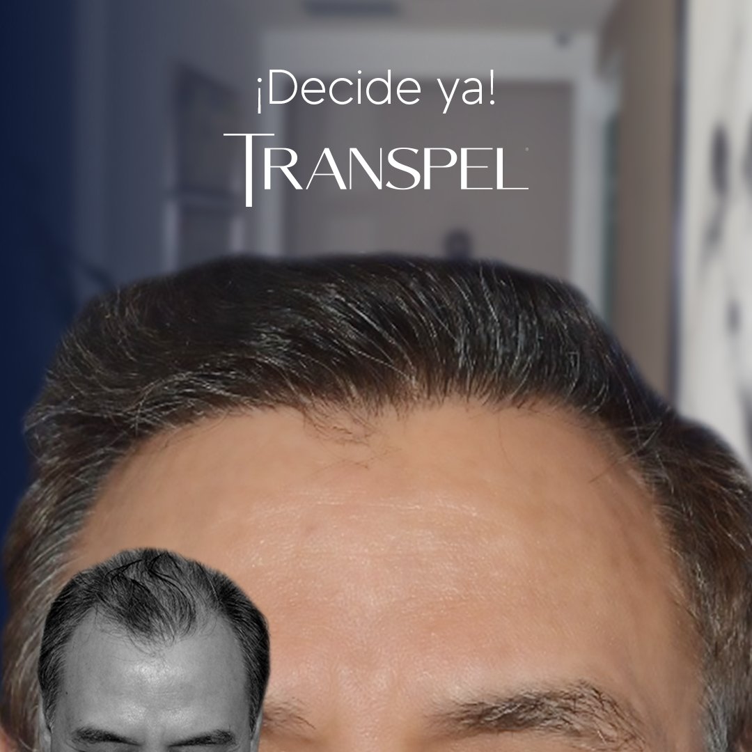 Transpel1's tweet photo. Elige recuperar tu cabello
Transpel, un mundo de posibilidades

WhatsApp +52 55 4352 8607 https://t.co/W56qMoJkSJ