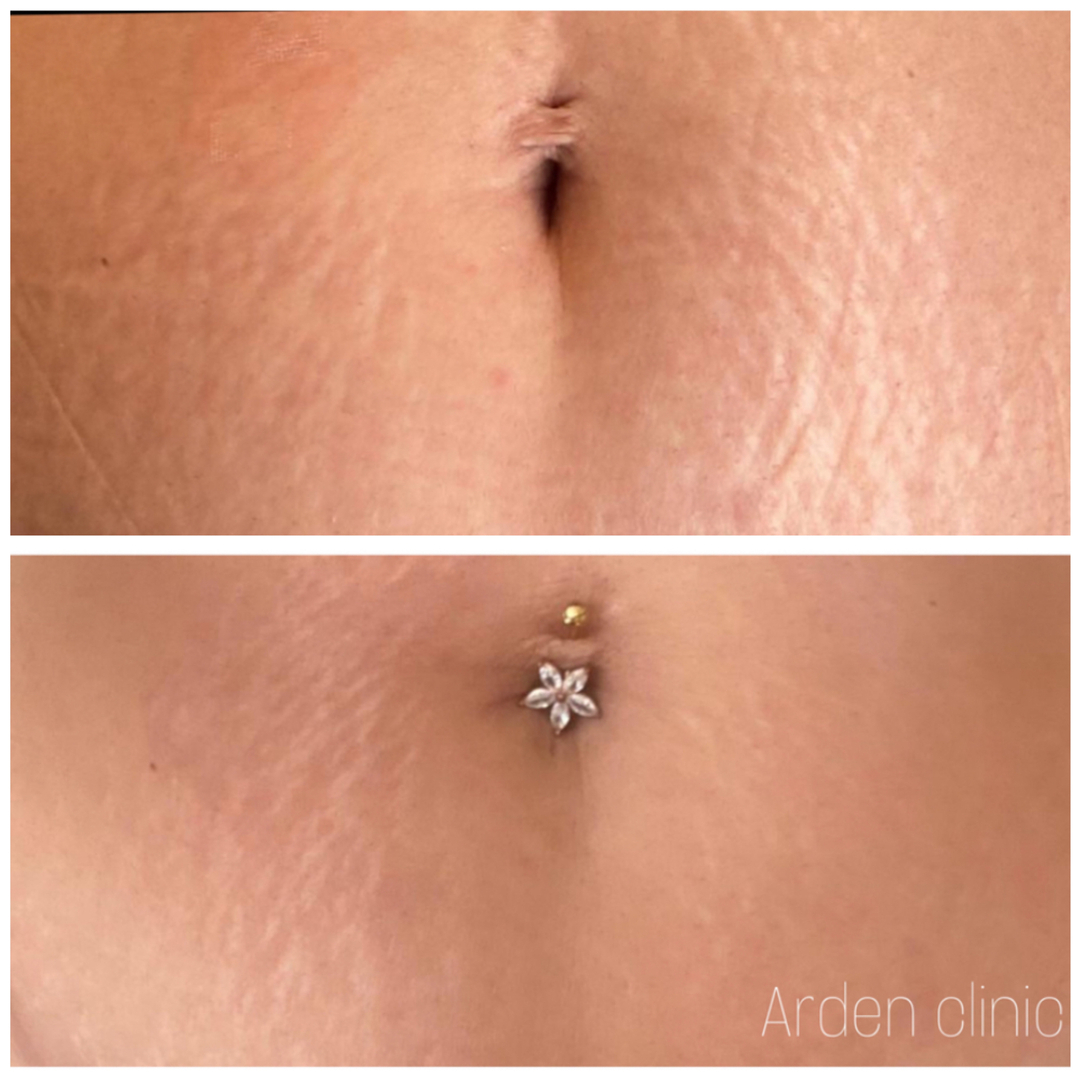 ArdenClinic's tweet photo. Result after ONLY 1 session of Morpheus Body 🪄#workingprogress

Reduce the appearance of #stretchmarks. Multiple sessions required - we normally recommend 6 sessions to see optimum result. 

@inmodeuk @inmodeaesthetics

⏰ 70 minutes treatment 
⏳ Results seen in 4 weeks
� https://t.co/e0nJf4XyYc