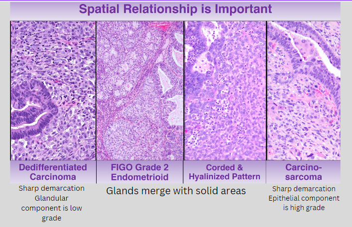Deceptive Mimics in Gynecological biopsies
Dr Turashvili #USCAP2023 #everydayGYN #GYNpath #PathTwitter #pathology #pathologist #pathresidents