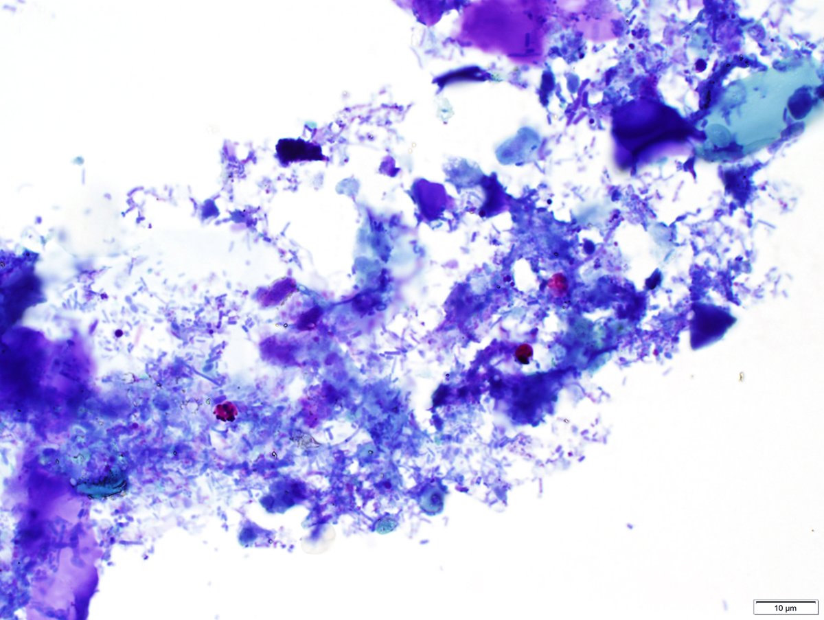 ParasiteGal's tweet photo. The #Parasite Case 721 is up: stool specimen on modified AF stain and calcofluor white. Patient with 1+ weeks profuse watery diarrhea. https://t.co/MiJaZ81y3Z ID? Is this a fungus or parasite?
#mayopath#pathology #IDPath #CrittersOnTwitter #PathBugs https://t.co/grZq3dP5dd