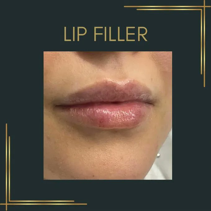 LtdSmooth's tweet photo. We can’t believe how beautiful these lips look 👄

Natural and subtle, the Smooth Dimensions way 🥰

We work with you to establish exactly what you’re looking for before undergoing treatment 💚

Book in today for a consultation 💌
#lipfiller #smoothdimensionsltd #subtle https://t.co/gA6Br07dIT