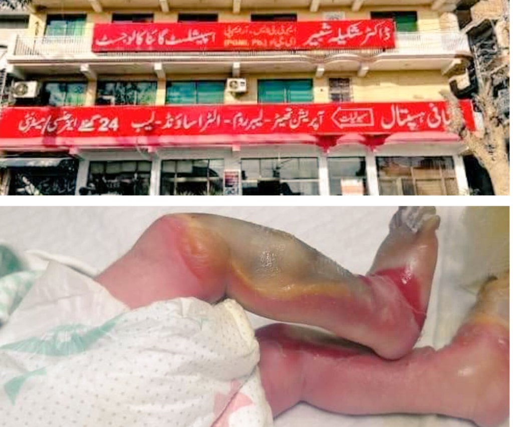 aliimranabbasi's tweet photo. اسلام آبادعلی پورمیں شکیلہ ہسپتال انتظامیہ کی غفلت،نومولودبچی دونوں ٹانگوں سےمعذورہو گئی بچی کی انکیوبیٹرمیں دونوں ٹانگیں جل گئیں قبل ازوقت پیدائش پرانکیوبیٹرمیں بچی کو1دن بعددیکھاتوپاوں جلےہوئے تھےبچی کوالرجی کاکہہ کرپٹی باندھ کرزخم چھپانے کی کوشش کی گئی والد،کیاکوئی نوٹس لےگا؟ https://t.co/FT5SpDUjrJ