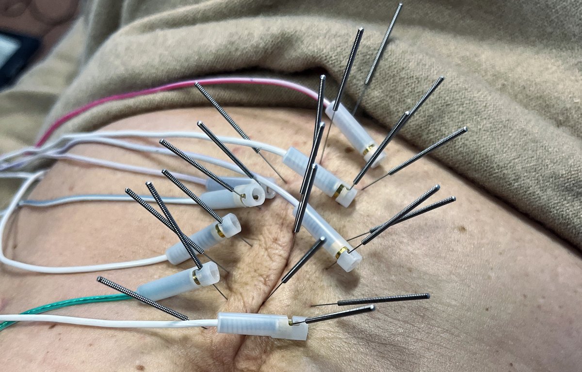 ZdrowieToMy's tweet photo. Elektroakupunktura jest połączeniem klasycznej akupunktury oraz prądu, za pomocą którego można oddziaływać na wybrane punkty akupunkturowe w ciele https://t.co/vOxh0AKbPV #elektroakupunktura #zdrowietomy #piaseczno #józefosław #fizjoterapia #medycynanaturalna https://t.co/F0iNd74BhE