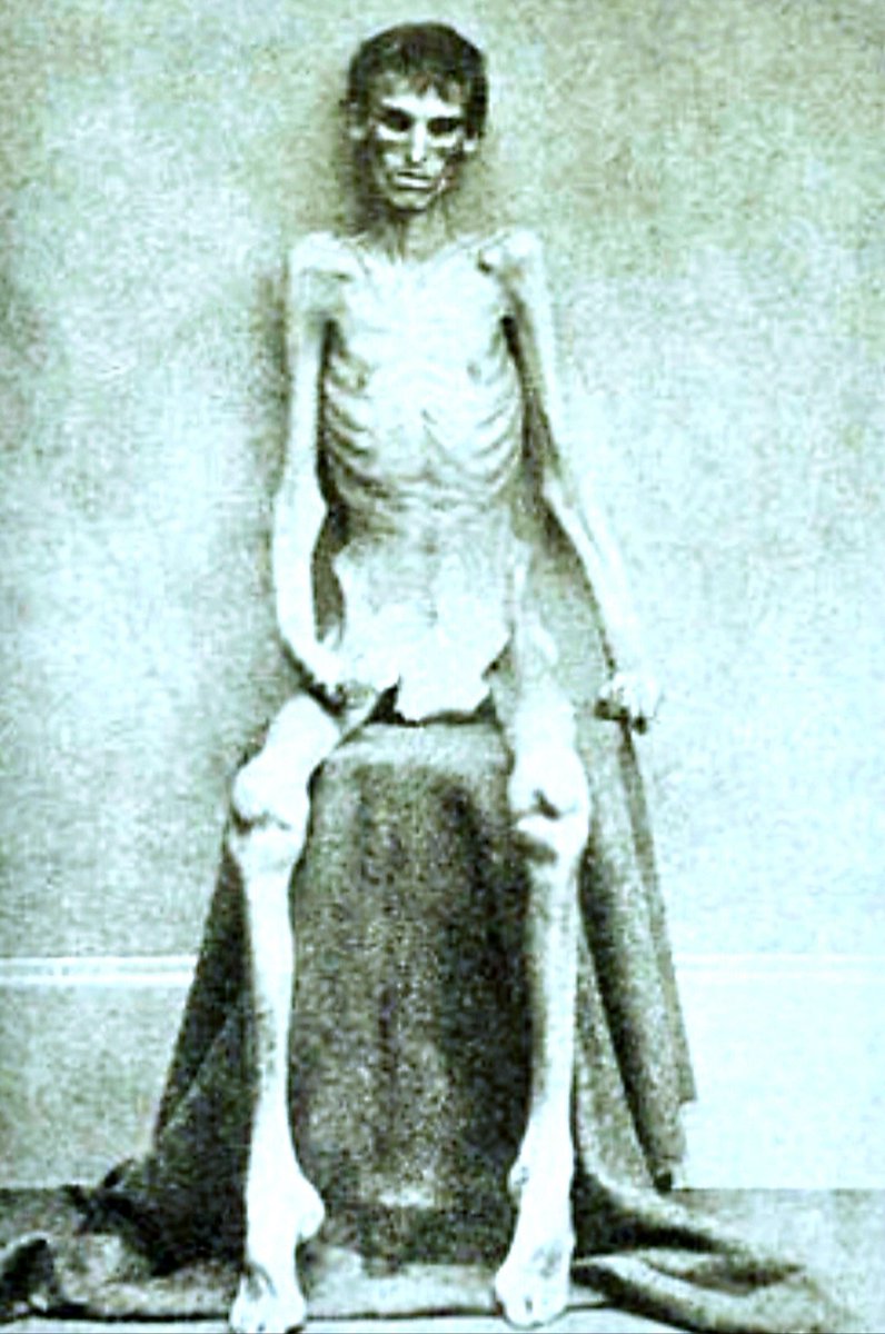 🌿🇺🇸🌿 Any of you losers who think you deserve reparations...take a trip to a Civil War cemetary or look at the pictires of Union soldiers, like this guy, in the  Andersonville prisoner camp and know YOU owe a debt you can never repay.