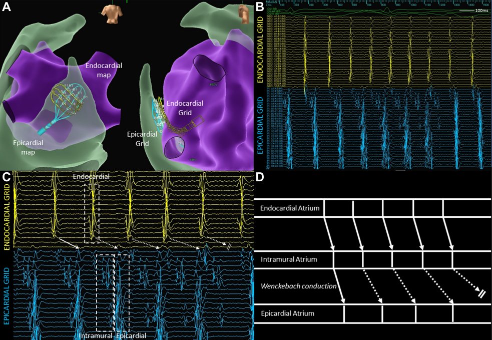 Chris Wong (@wongchrisx) on Twitter photo #EPeeps
Endo-to-epi Wenckebach conduction in the posterior left atrium
Further evidence for #AFin3D with Drs Randall Lee & <a href="/StaceyHowellMD/">Stacey Howell</a> at <a href="/UCSF/">UC San Francisco</a> <a href="/HeartUCSF/">UCSF Heart & Vascular Care</a>
Free access via <a href="/JACCJournals/">JACC Journals</a> EP link🔽for 1 month
rb.gy/3qo2c #EPeeps
Endo-to-epi Wenckebach conduction in the posterior left atrium
Further evidence for #AFin3D with Drs Randall Lee & <a href="/StaceyHowellMD/">Stacey Howell</a> at <a href="/UCSF/">UC San Francisco</a> <a href="/HeartUCSF/">UCSF Heart & Vascular Care</a>
Free access via <a href="/JACCJournals/">JACC Journals</a> EP link🔽for 1 month
rb.gy/3qo2c