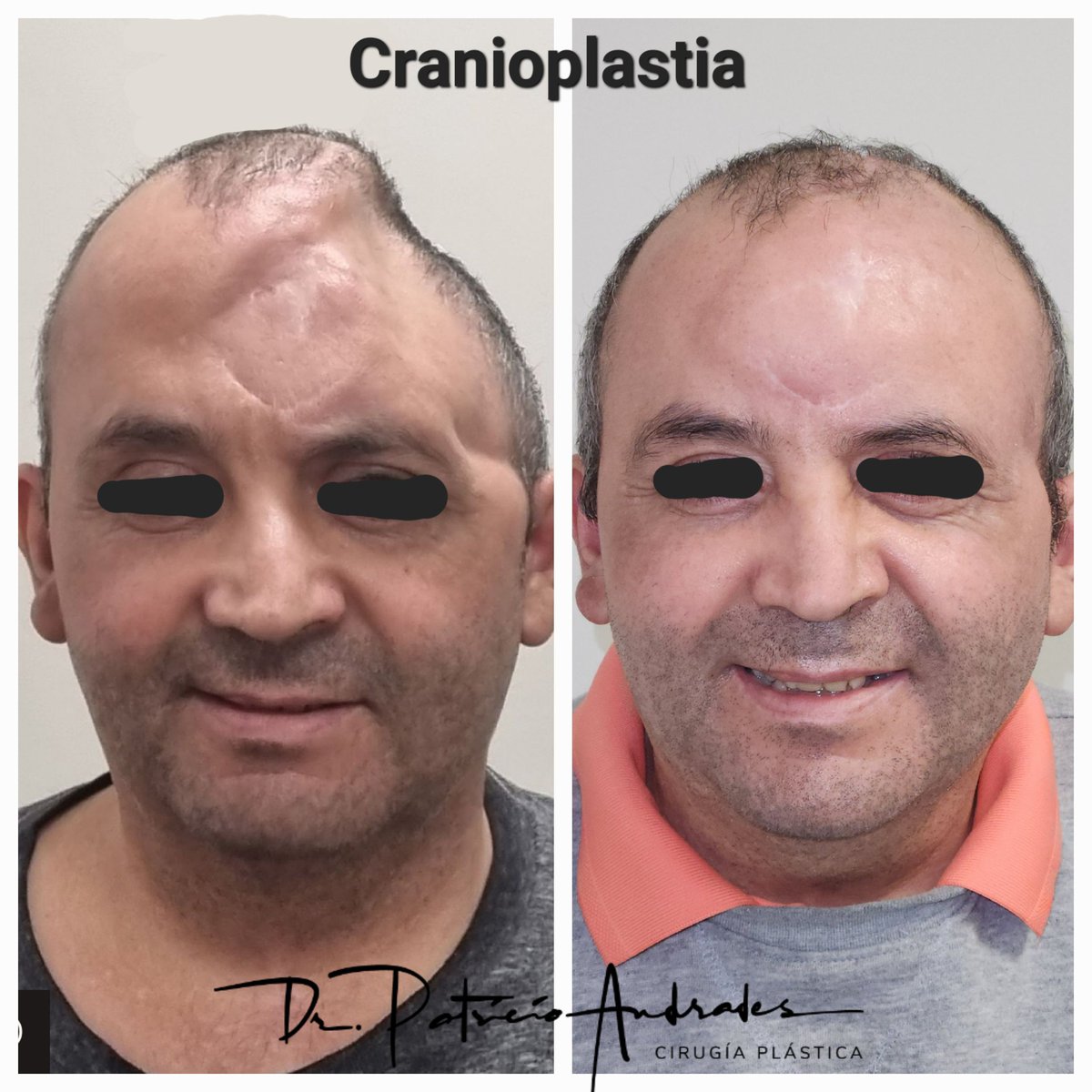 La Cranioplastia o Reconstrucción del Cráneo es una cirugía que permite devolver la anatomía y contorno normal del cráneo. Pero más que eso permite devolver la alegría a nuestros pacientes