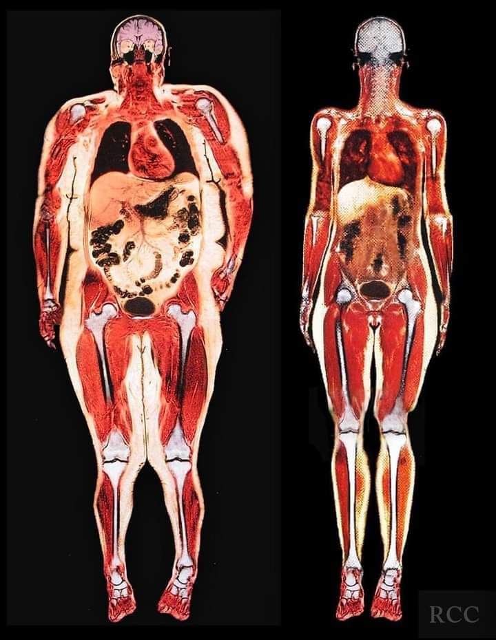 Esta imagen es un escáner corporal de una chica con 113 kg y otra con 54 kg, se pueden apreciar diferencias abismales.

El tamaño del corazón, intestinos y estómago son excesivos. Los huesos prácticamente han modificado su posición y el líquido que hay entre el cráneo y el
