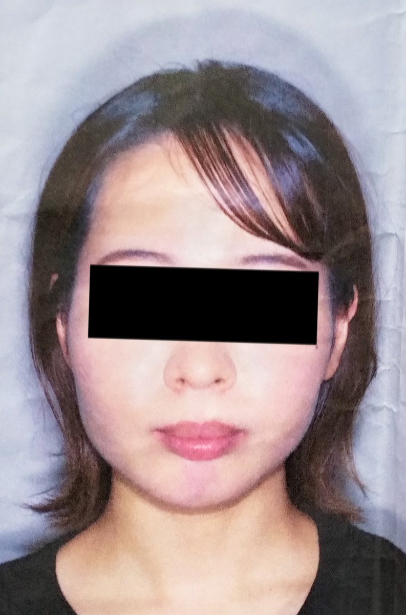 c_chanlan's tweet photo. 🤍上顎前突・下顎後退(顎変形症・保険適用）
🤍上下表ワイヤー
🤍開始 術前矯正 2023年4月11日~
🤍調整・ワイヤー交換・抜歯は別途かかる
🤍調整2ヶ月に1回
🤍手術は2025年の春頃🌷
🤍悩み 前歯が出てるため上手く口を閉じれない・口呼吸・ゴボ・顔の歪み等 https://t.co/fVPsRtds0J