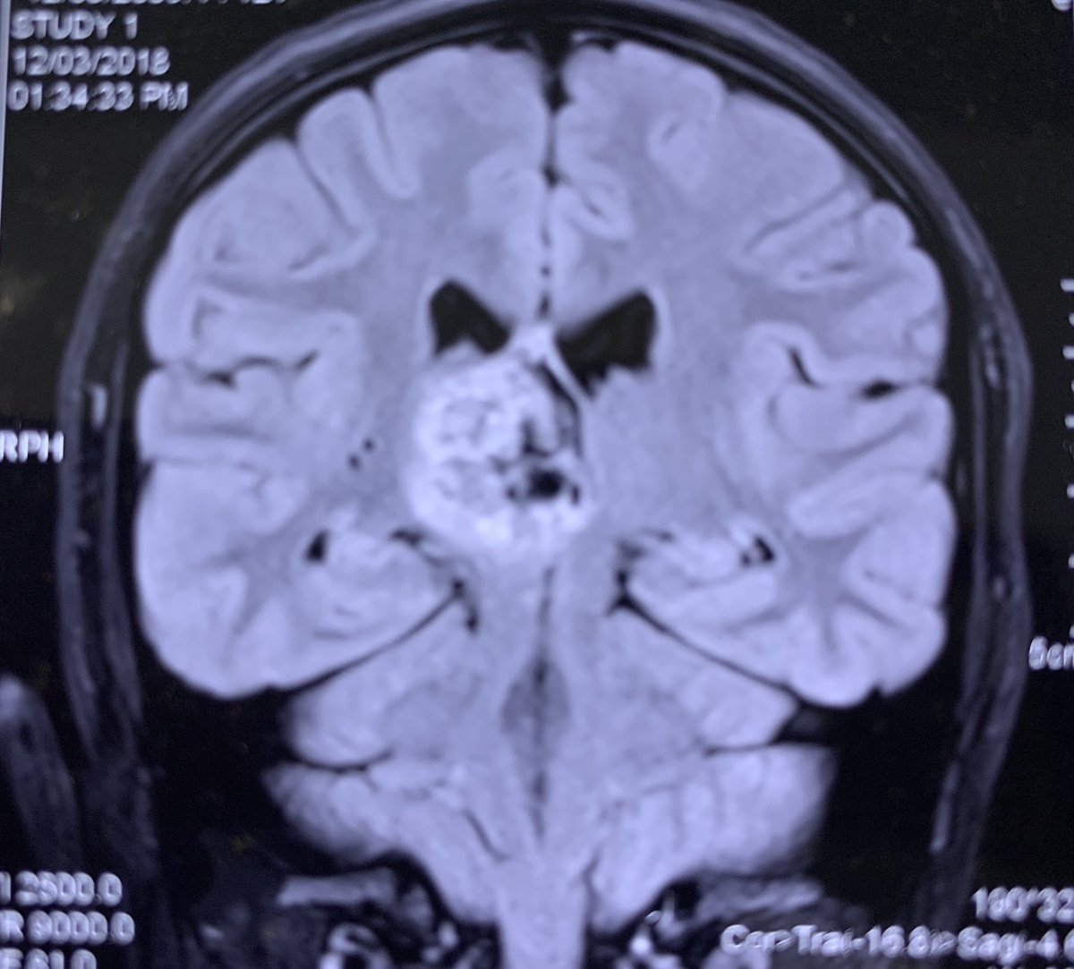 XRPL__A's tweet photo. Symptomatic left Holmes tremor ( postural and intentional > rest) coarse proximal > distal upper and lower limb tremor. Bubbly thalami’s lesion on the right-Bx awaited https://t.co/q93rWL1b67